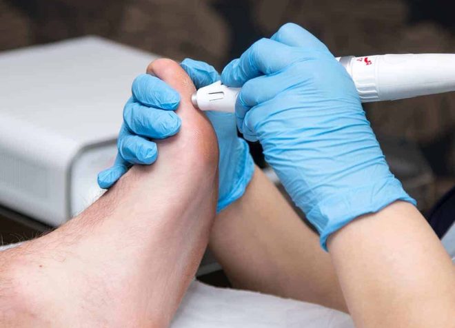 SWIFT Verruca Treatment