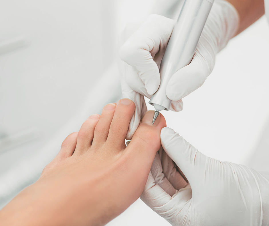 Dark vertical lines on your toenails — causes and treatment