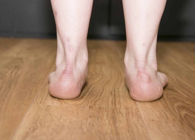 Flat Feet
