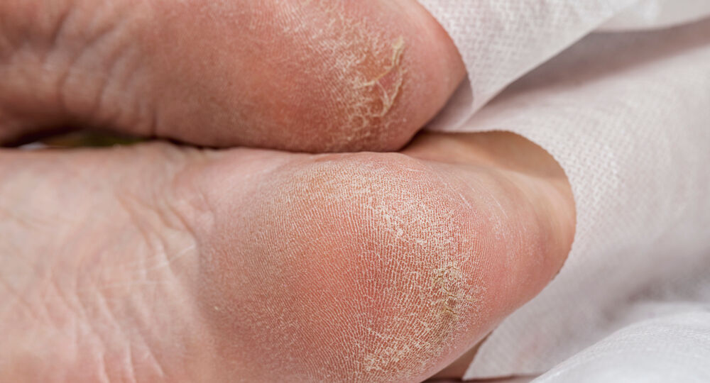 Why Your Feet Get Drier as You Age And How to Stop It