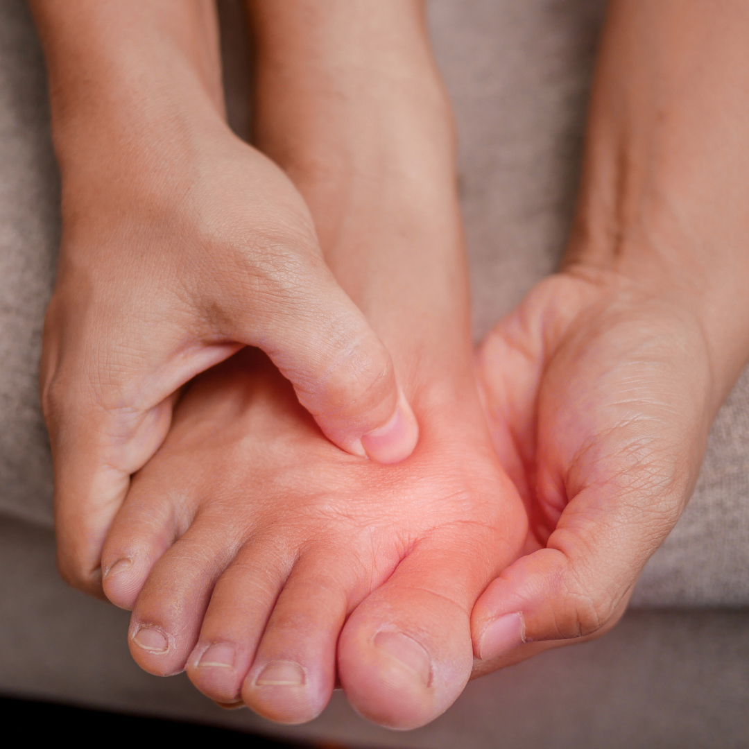 What Causes Bunions?