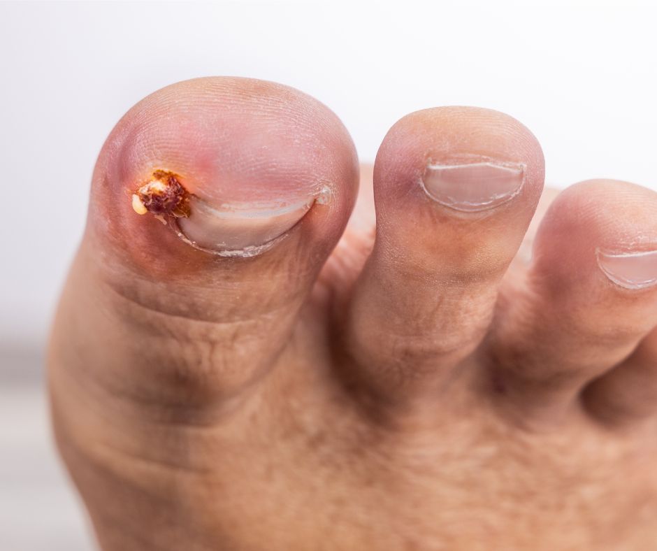 Callen_Olive_Podiatry_Clinic_Berkhamsted_near_Hemel_Hempstead_and_Tring_toenail surgery Berkhamsted ingrown toenail ingrown toenail removal cure ingrown toenail