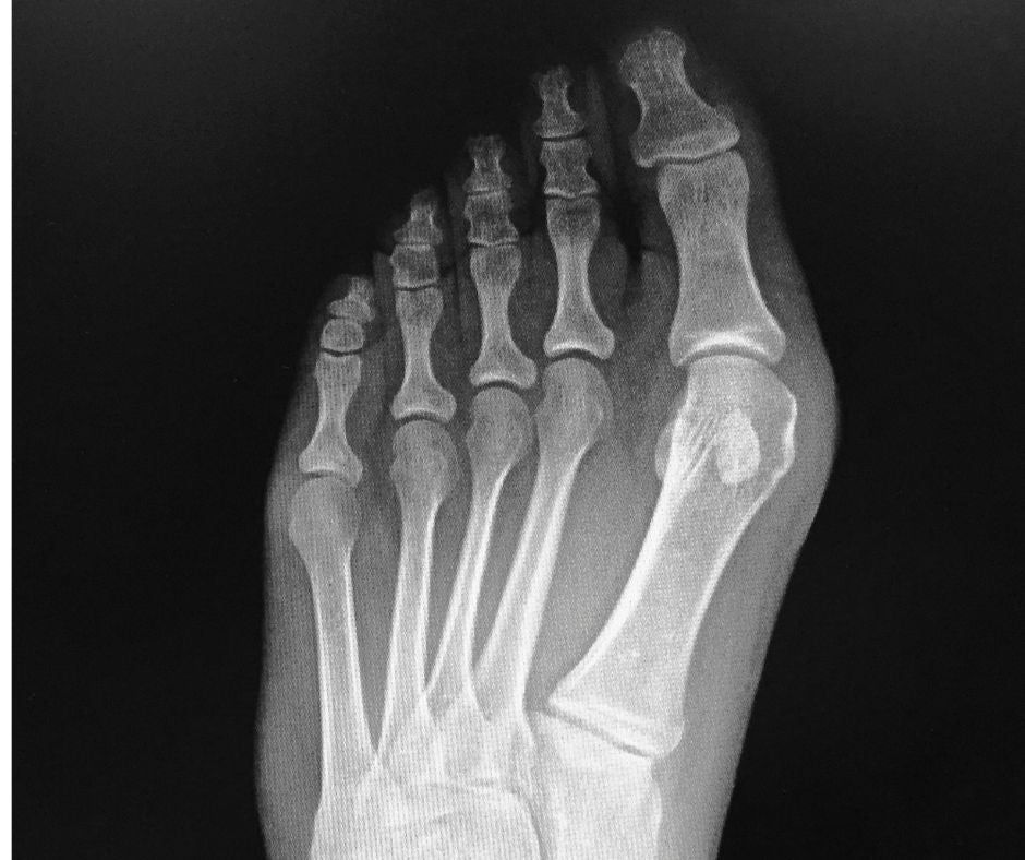 Callen_Olive_Berkamsted_podiatry_chiropody_clinic_Berkhamsted_near_Hemel_Hempstead_Tring_Bunions_Foot_Pain_bunion_causes_and_treatment Bunions | Causes | Prevention | Treatment