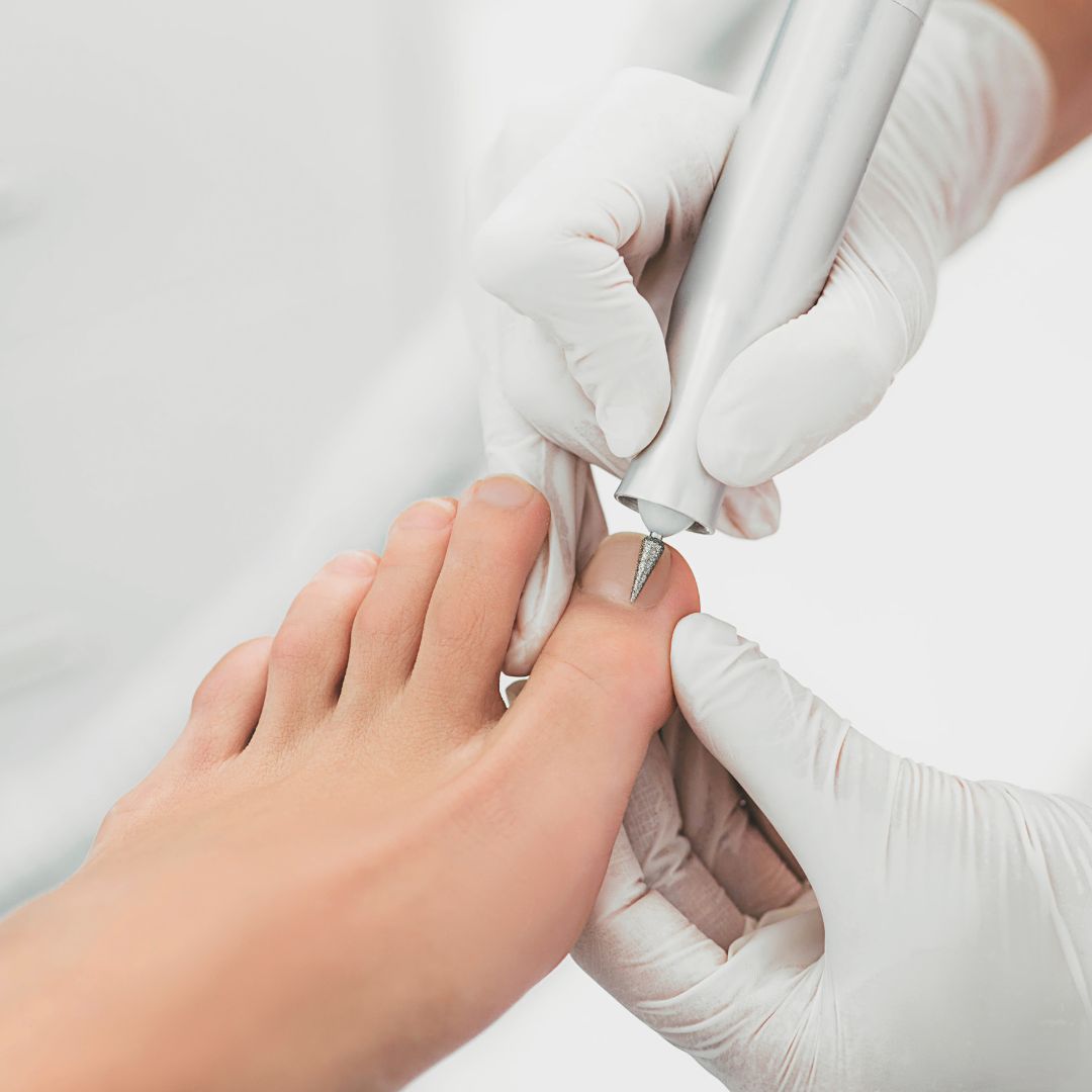 Keryflex toenail restoration. Instant results. | Toe nails, Fun nails, Nails