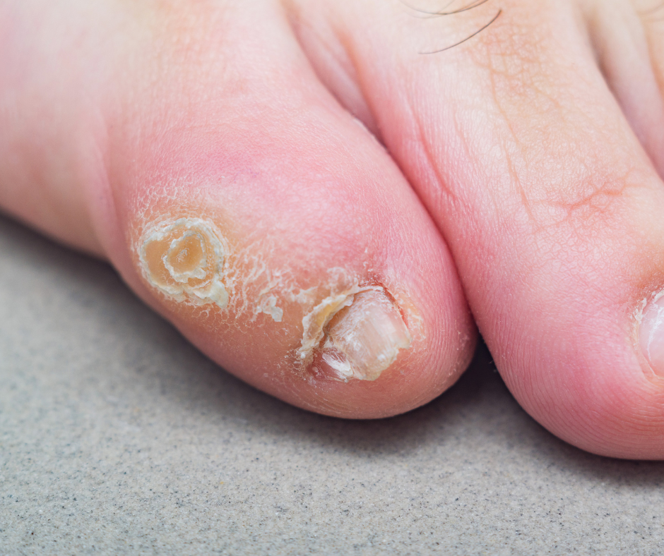 Corns & Calluses | Causes | Prevention | Treatment – Callen Olive