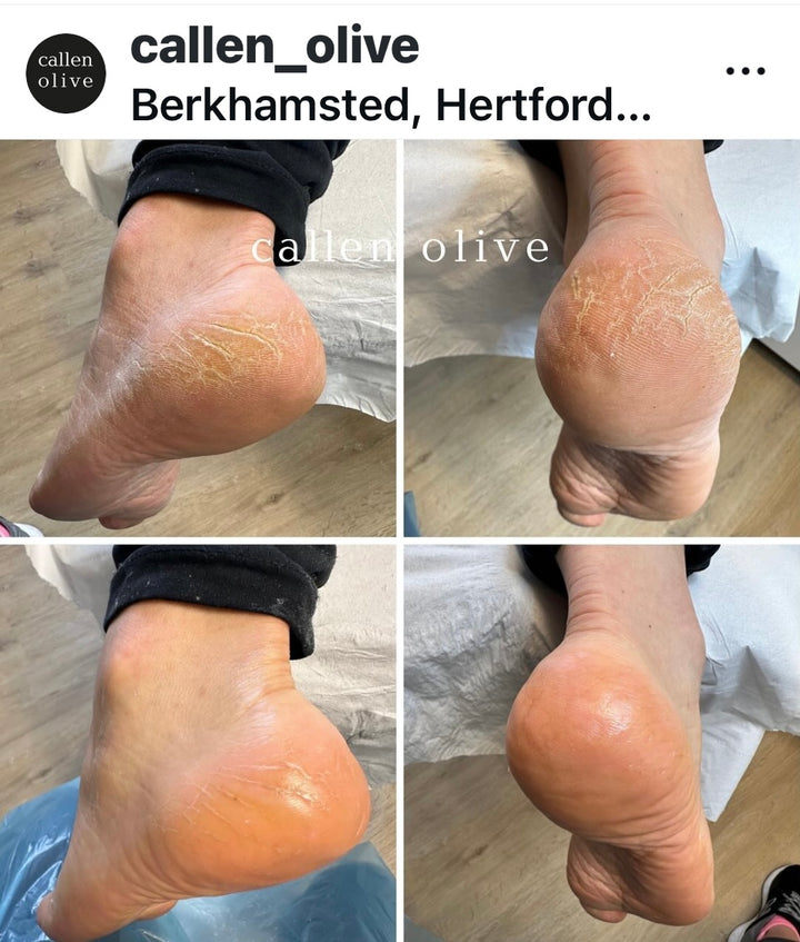 heel balm for cracked heels 