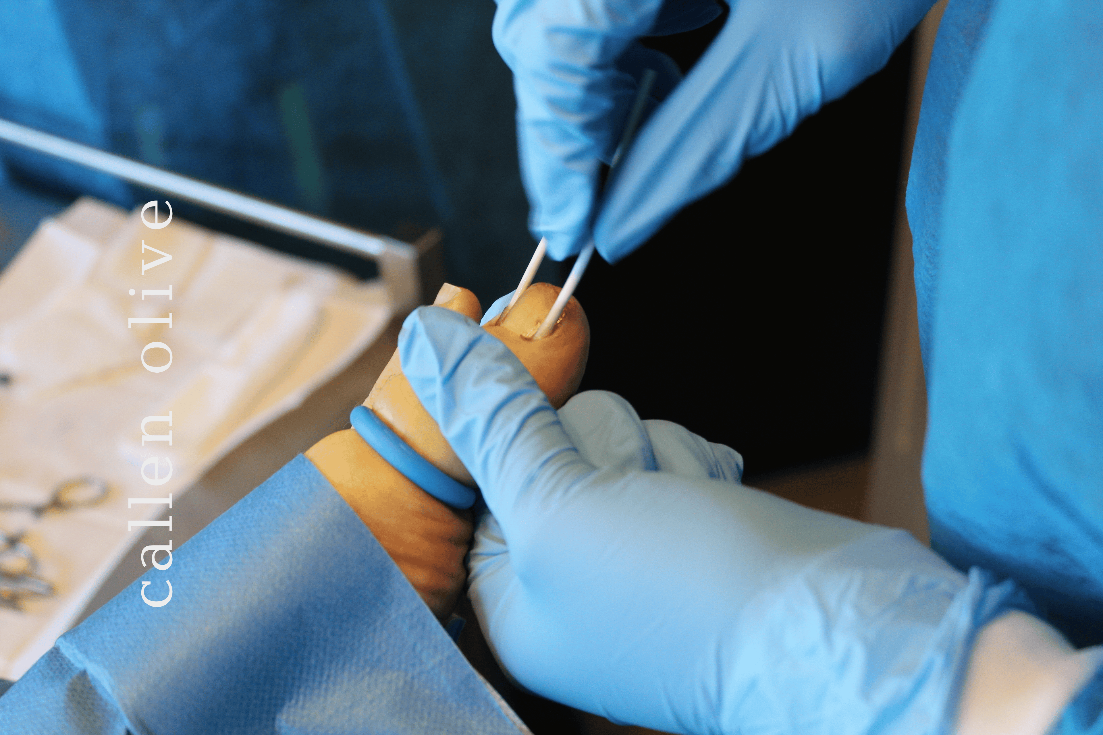 Ingrown toenail treatment 